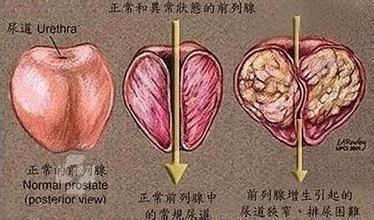 河池什么是前列腺结石