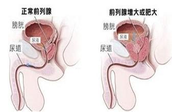 前列腺增生不同阶段的症状表现？