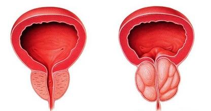 前列腺囊肿会给患者带来什么影响